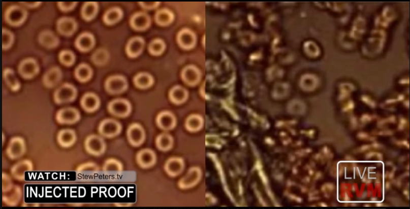 COMPARISON OF BLOOD UNDER MICROSCOPE PHOTOS BEFORE AND AFTER THE COVID-19 INJECTION